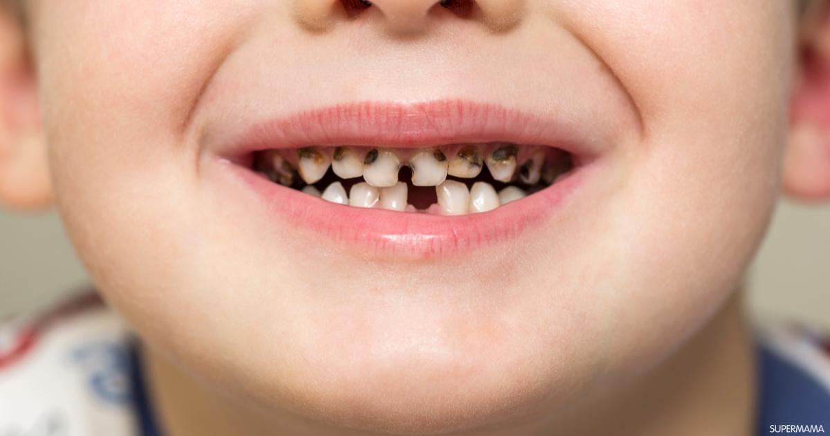 تسوس الاسنان عند الاطفال